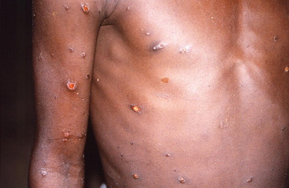A person suffering from monkeypox | Image: Pinterest