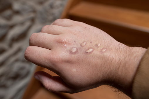 Monkey pox vesicles in a hand | Image: Pinterest