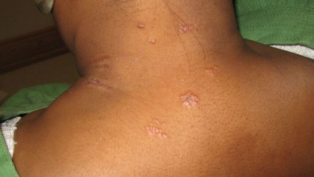 Skin Symptoms of Sarcoidosis