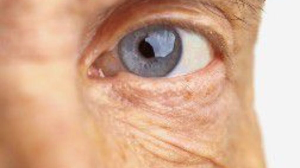 Sarcoidosis around the eye