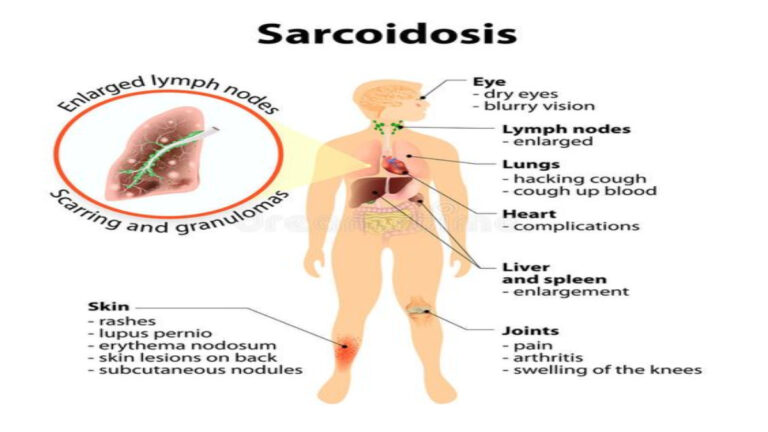 These Are the Symptoms and Risk Factors Associated With Sarcoidosis