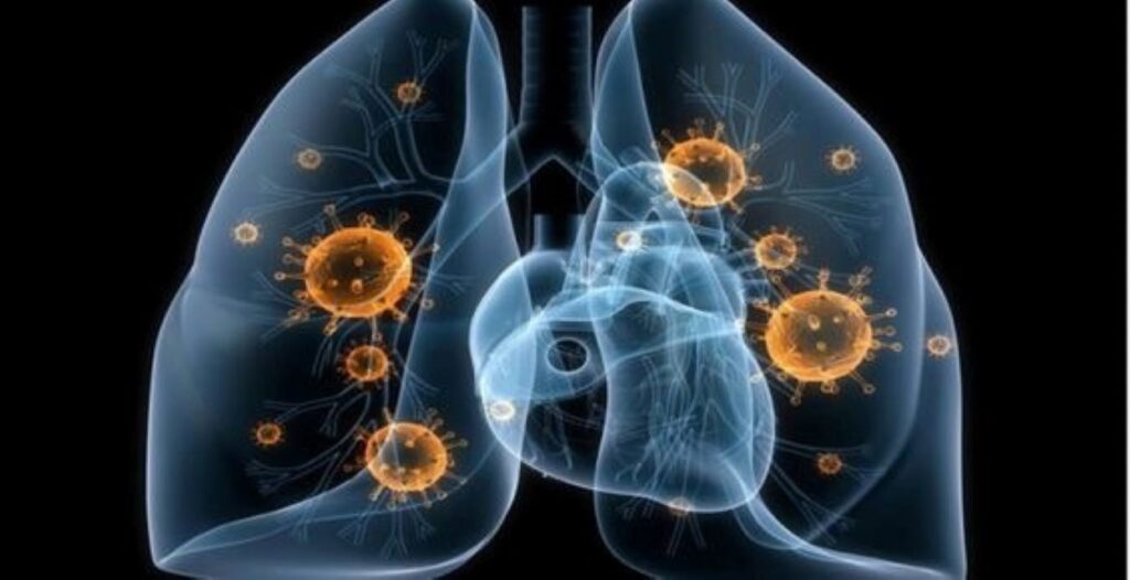 Tuberculosis in the lungs