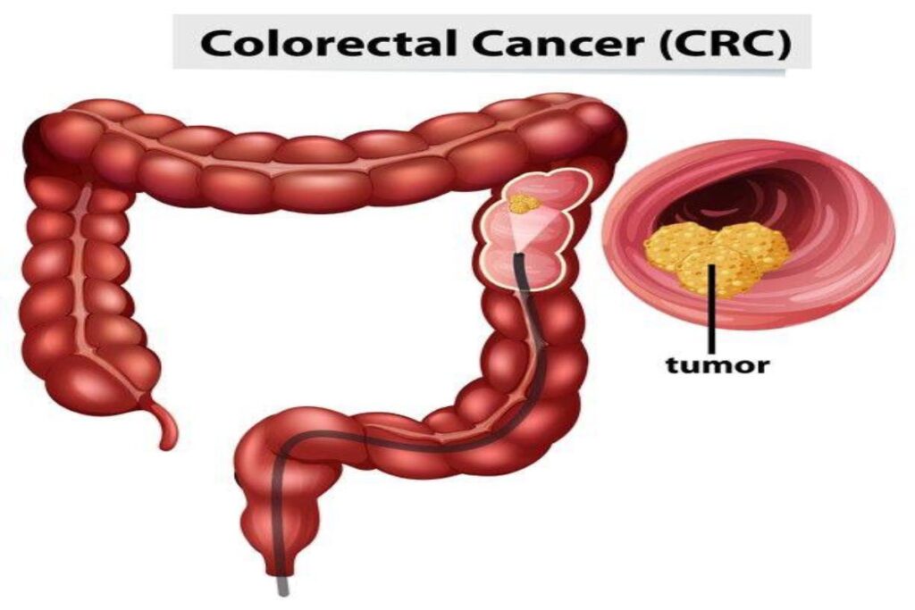 A picture of colorectal cancer