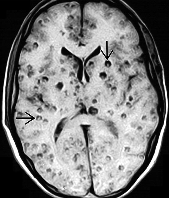 Neurocysticercosis