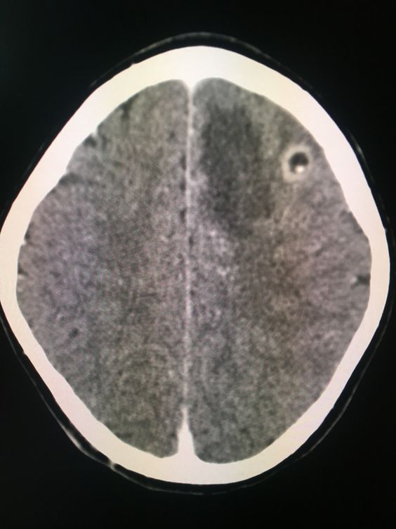 Neurocysticercosis