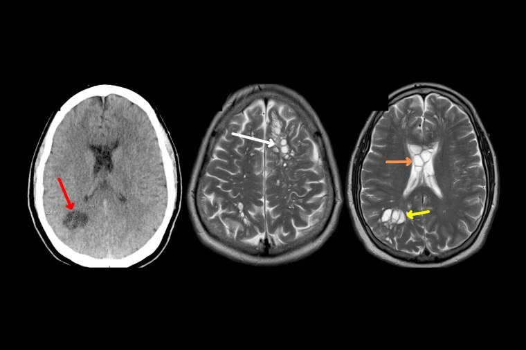 Neurocysticercosis