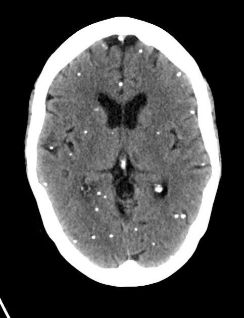 Neurocysticercosis