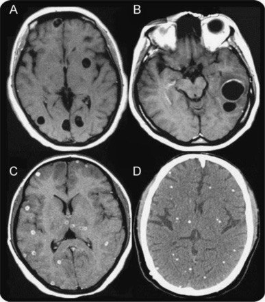 Neurocysticercosis