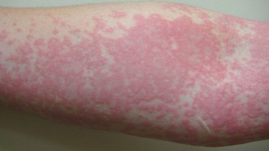 A person holding their arm out with a large hive rash.