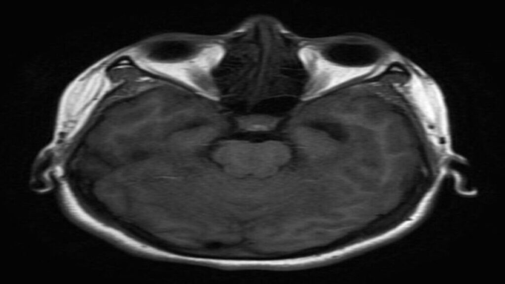 Neurocysticercosis