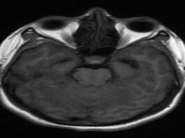 Neurocysticercosis