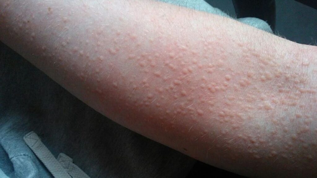 A person holding their arm out with a large hive rash.