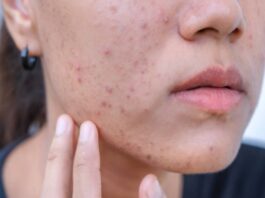 A picture of an acne-prone skin