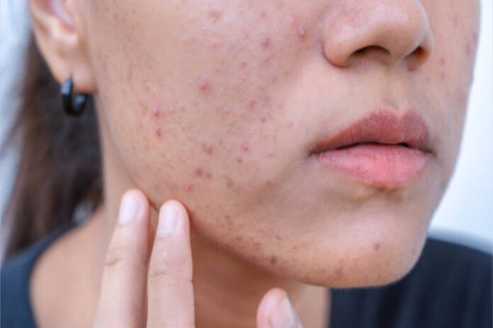 A picture of an acne-prone skin