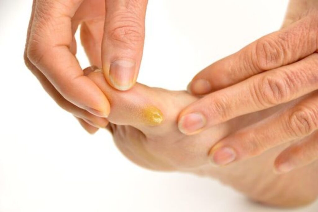 A picture of a foot with corn and callous